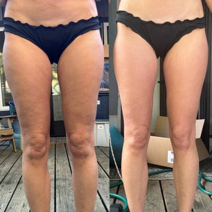 Cellulite & Circulation Boost Massager